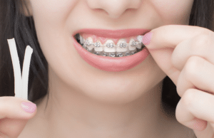 CERA DENTAL PARA BRACKETS