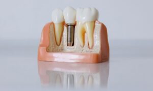 implantes dentales 