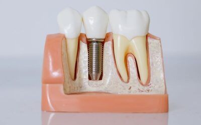 Implantes dentales: una solución duradera para recuperar tu sonrisa